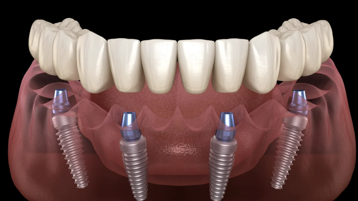 All-on-4 dental implants
