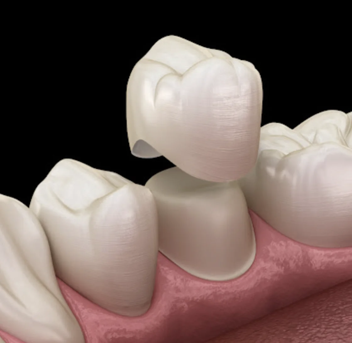 Dental crowns