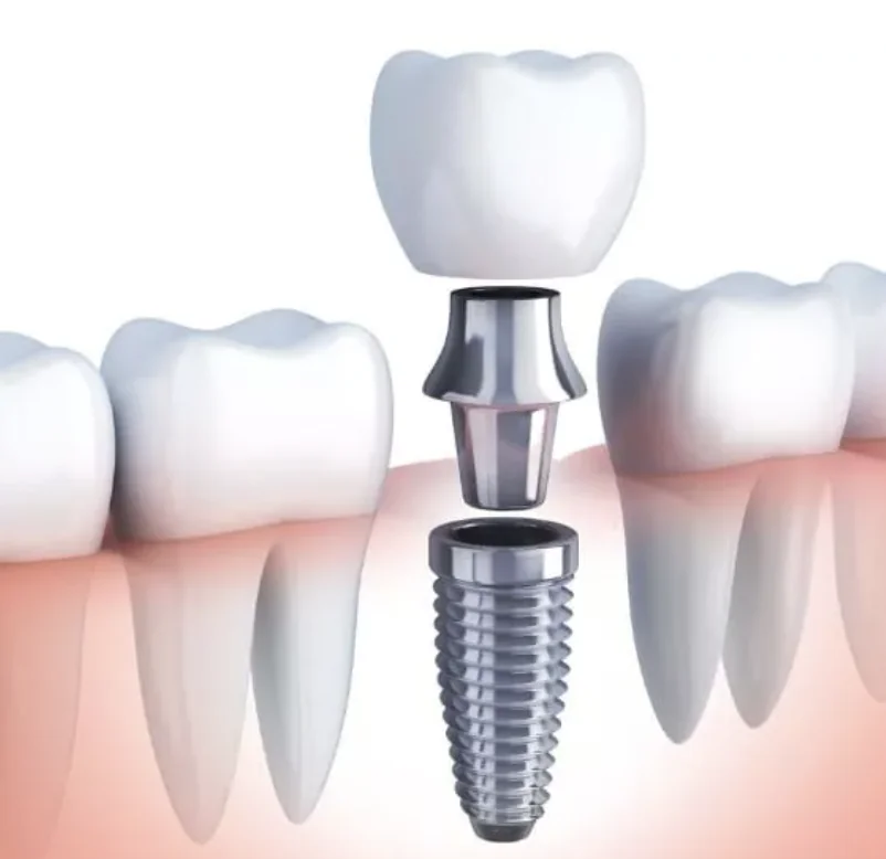 Single dental implant